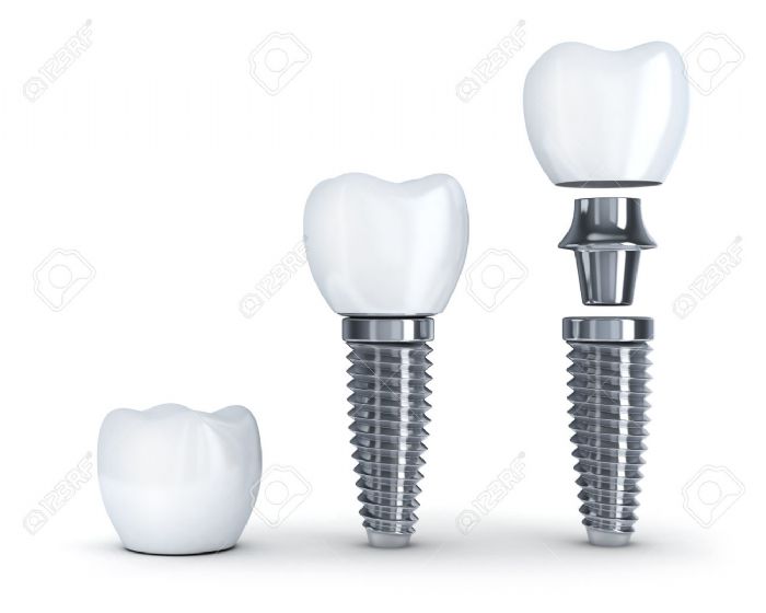 Implante Dental 3.5mm - TOP IMPLANTS
