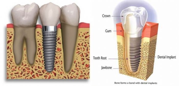 Implante dental 4.2mm - Top Implants